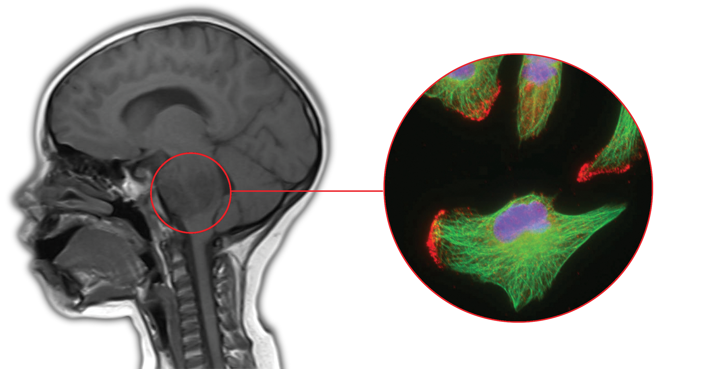 Tumor Brainstem Glioma